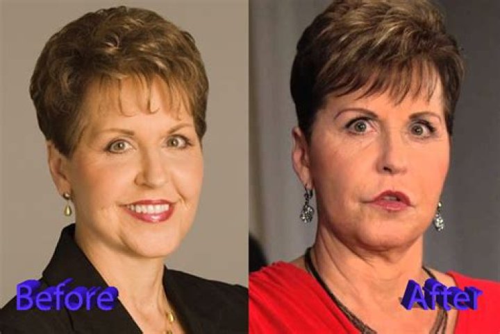 Discover The Joyce Meyer Face Lift
