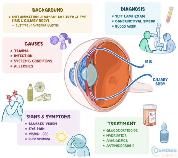 Understanding Iridocyclitis in Kids: Symptoms, Causes, and Treatment